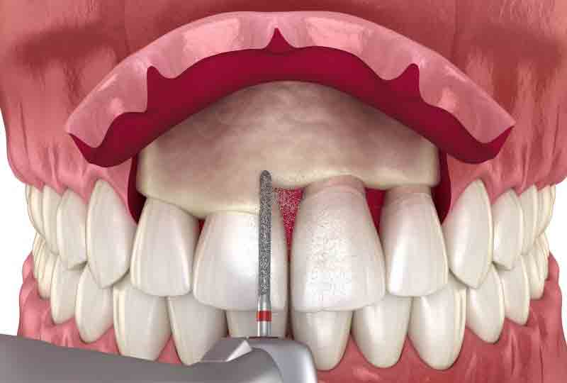 Crown Lengthening Procedure Yuma