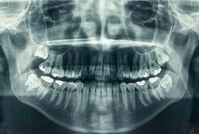Panoramic Dental X-Ray