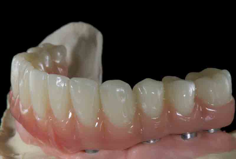 all-on-four-acrylic-dental