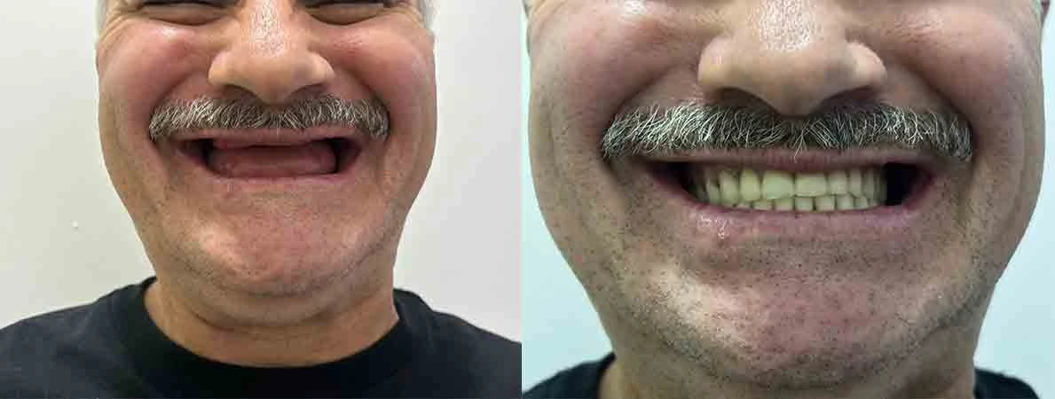 all-on-four-before-and-after-yuma