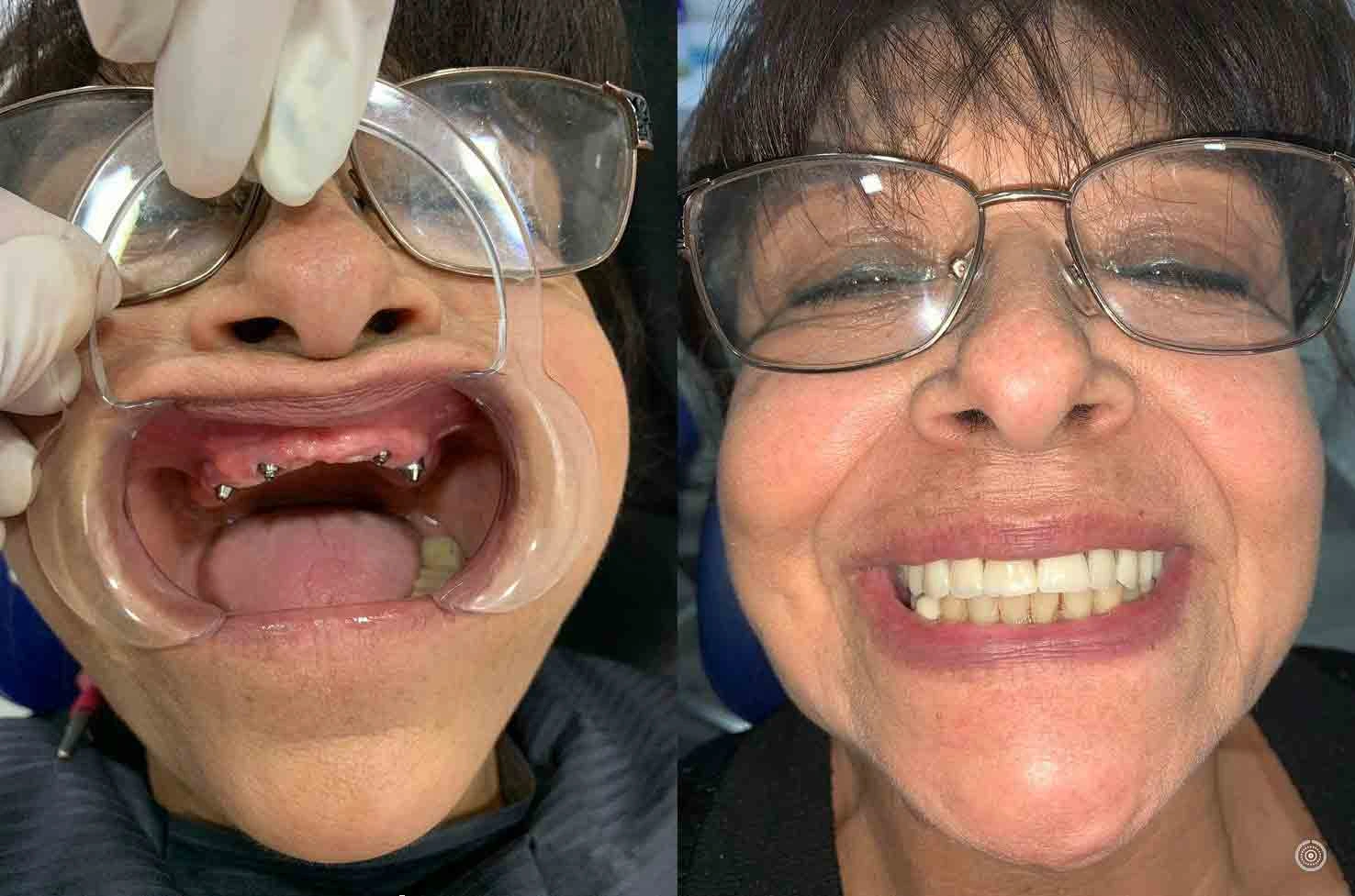 all-on-four-before-and-after-yuma2