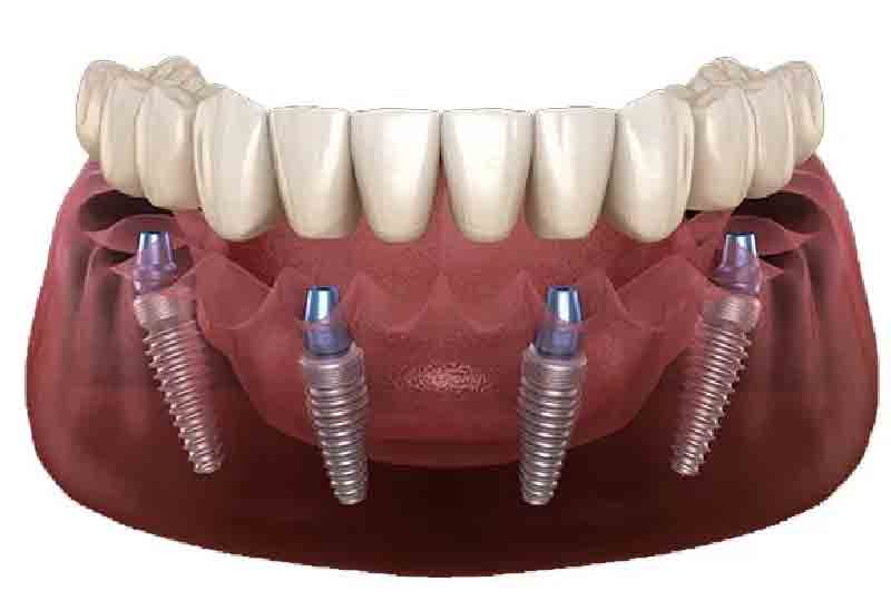 all-on-four-dental-zirconia-implants-yuma