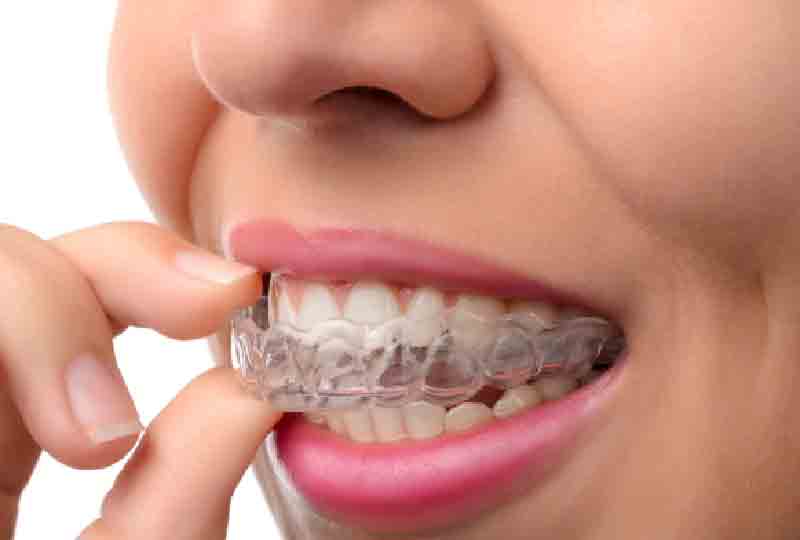 night-guard-teeth-yuma