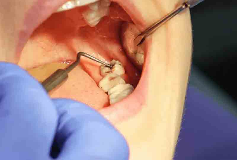 wisdom-tooth-extraction-yuma