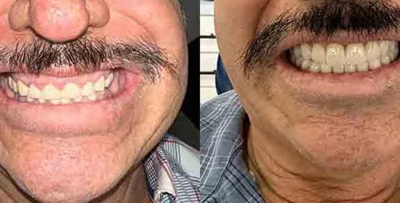 antes-y-despues-rehabilitación-completa-con-coronas-de-zirconia-yuma