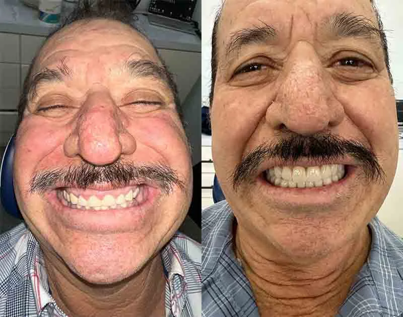 Coronas Zirconia