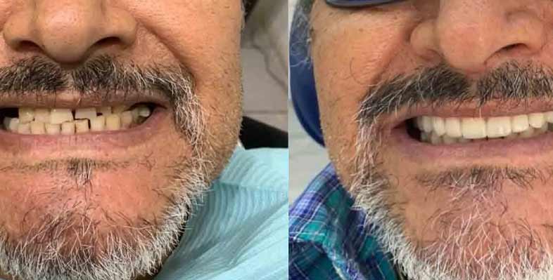 zirconia-crown-before-and-after-yuma