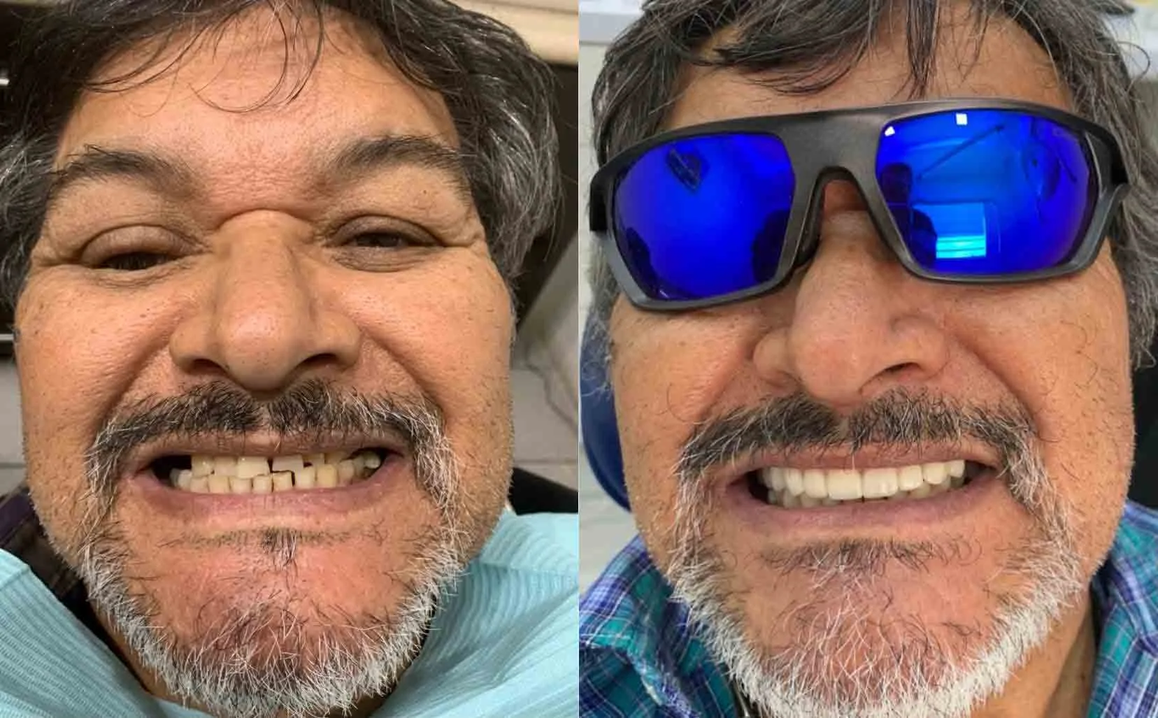 zirconia-crown-before-and-after-yuma